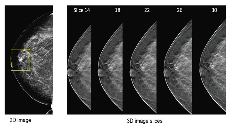 A visual comparison showing how a 2D mammogram sees all tissue at once, while 3D tomosynthesis creates multiple clear slices.