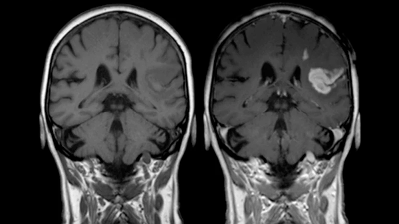 An MRI of a brain showing a brightly enhancing tumor after the administration of gadolinium contrast.