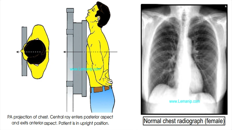 A diagram or photo showing the correct patient positioning for a PA chest X-ray.