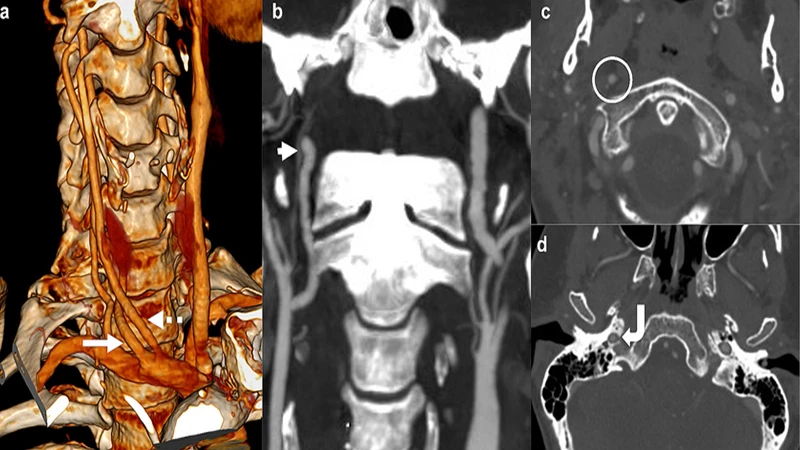 A 3D reconstruction from a CTA of the brain's Circle of Willis, showing the intricate network of arteries.