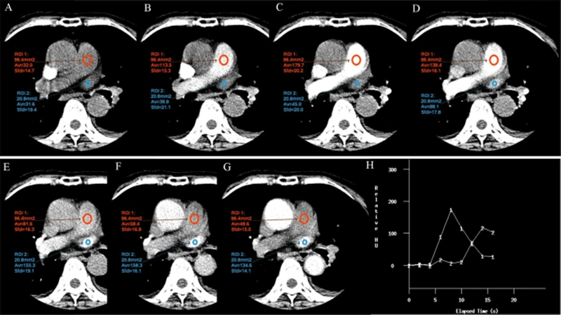 A diagram illustrating bolus tracking, showing contrast injection followed by a timed scan as the contrast reaches the target artery.