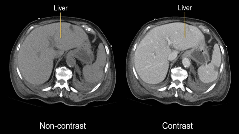 A side-by-side comparison of an abdominal CT scan without contrast and one with IV contrast, showing enhanced detail of the organs and vessels.