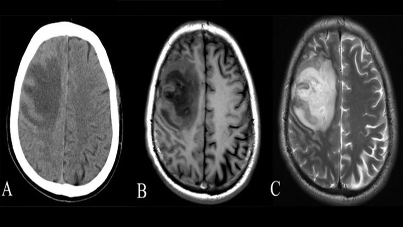 Side-by-side comparison of a CT scan and an MRI of a head, showing CT's detail in bone and MRI's superior detail in brain tissue.