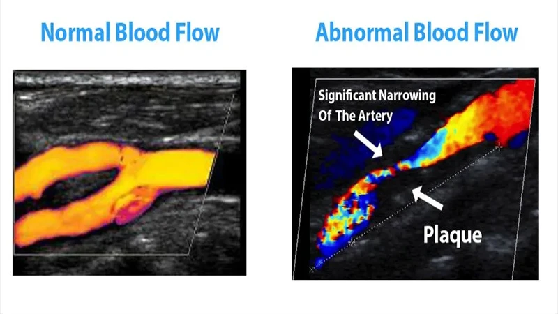 A color Doppler ultrasound image of a carotid artery showing blood flow in red and blue