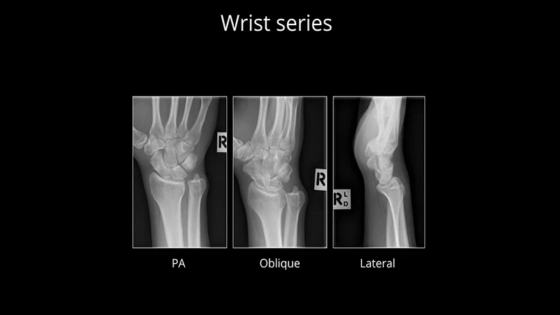 A composite image showing the patient positioning for PA, oblique, and lateral views of a hand.