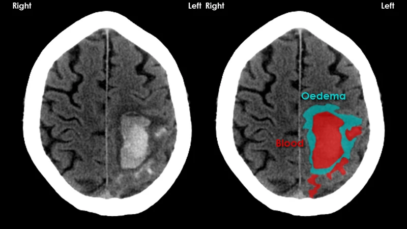 A head CT image clearly showing a large, bright area of acute bleeding, a typical STAT finding.