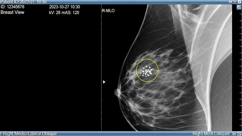A mammogram image with an AI overlay showing a circle around a suspicious cluster of microcalcifications.
