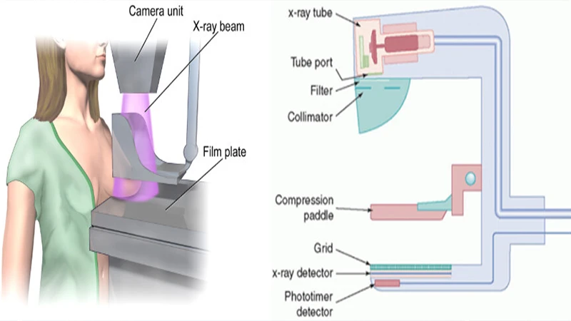 Diagram of a mammography machine showing the X-ray tube, compression paddle, and detector.