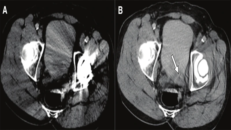 A CT scan of a pelvis with a hip replacement, showing severe streaking artifacts obscuring nearby anatomy.