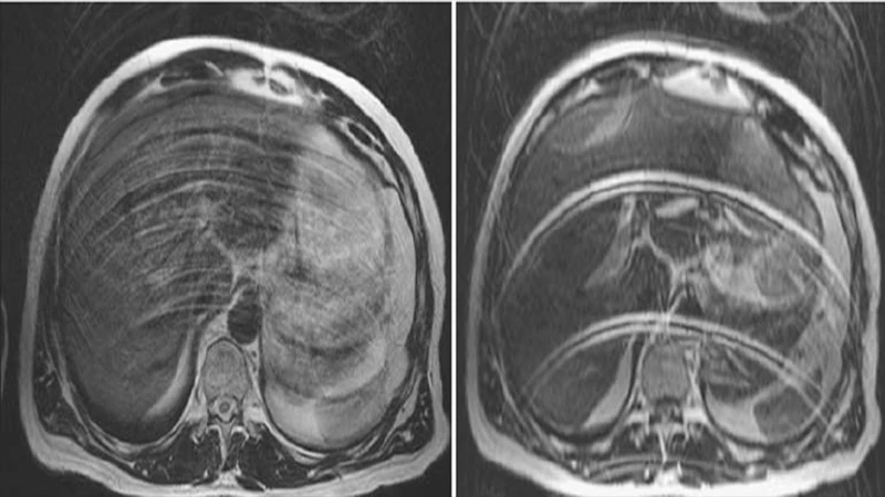 An axial MRI of the brain showing severe motion artifact, with ghosting and blurring across the image.
