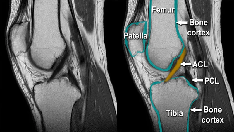 An MRI image of a human knee showing the intricate detail of the ligaments and soft tissues, possibly with a tear indicated