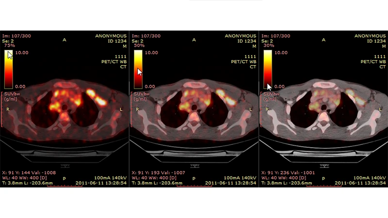 A fused PET/CT image of a cancer patient, showing bright spots of metabolic activity overlaid on a detailed anatomical CT image