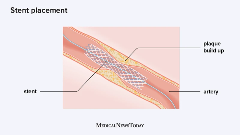 A diagram showing a catheter delivering a stent to open a blocked artery.