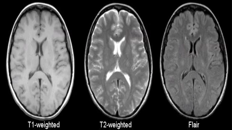 Side-by-side comparison of a T1-weighted and a T2-weighted MRI of a human brain, showing differences in fluid brightness