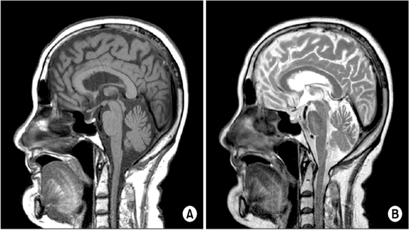 Side-by-side T1 and T2 MRIs of a brain, with labels showing that CSF is dark on T1 and bright on T2.