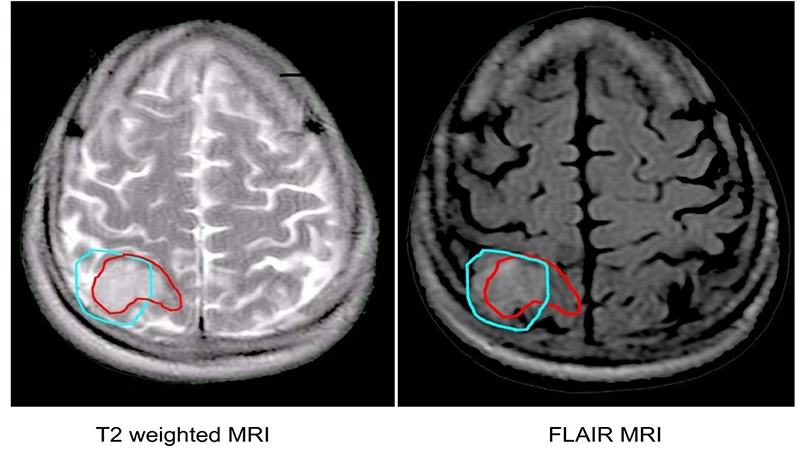 A T2 brain MRI next to a FLAIR image of the same patient, demonstrating how FLAIR darkens the CSF in the ventricles, making nearby pathology more visible.