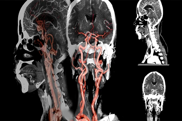 A 3D CTA reconstruction of arteries