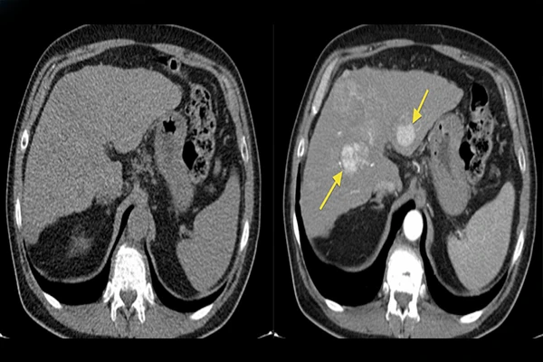 A close-up of an IV line in a patient's arm