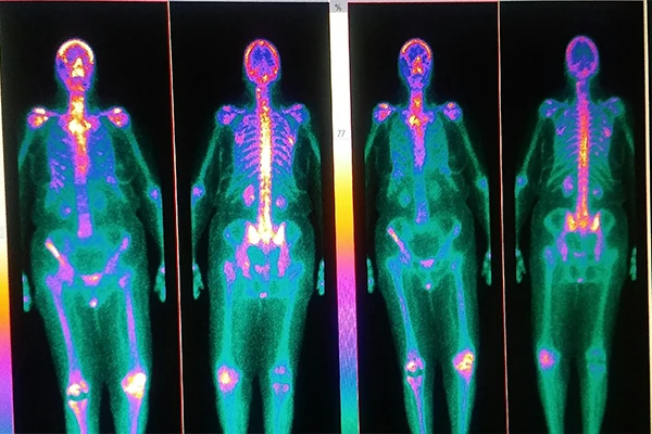 A colorful PET scan image of the human body
