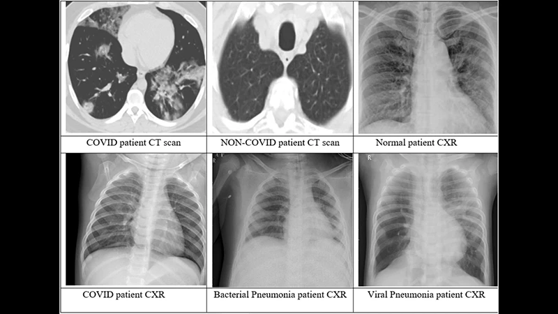 A side-by-side comparison of a chest X-ray and a single CT slice, showing the superior detail of the CT.